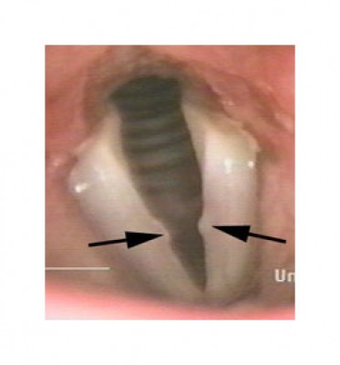 vocal_nodules2.jpg